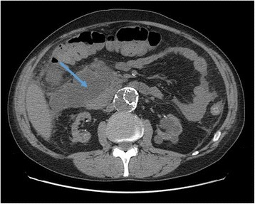 типичная боль в эпигастрии и иррадиация в спину (clinical+pancreatitis+pain) — источник: NLM Open-i, open access (NLM Open-i)