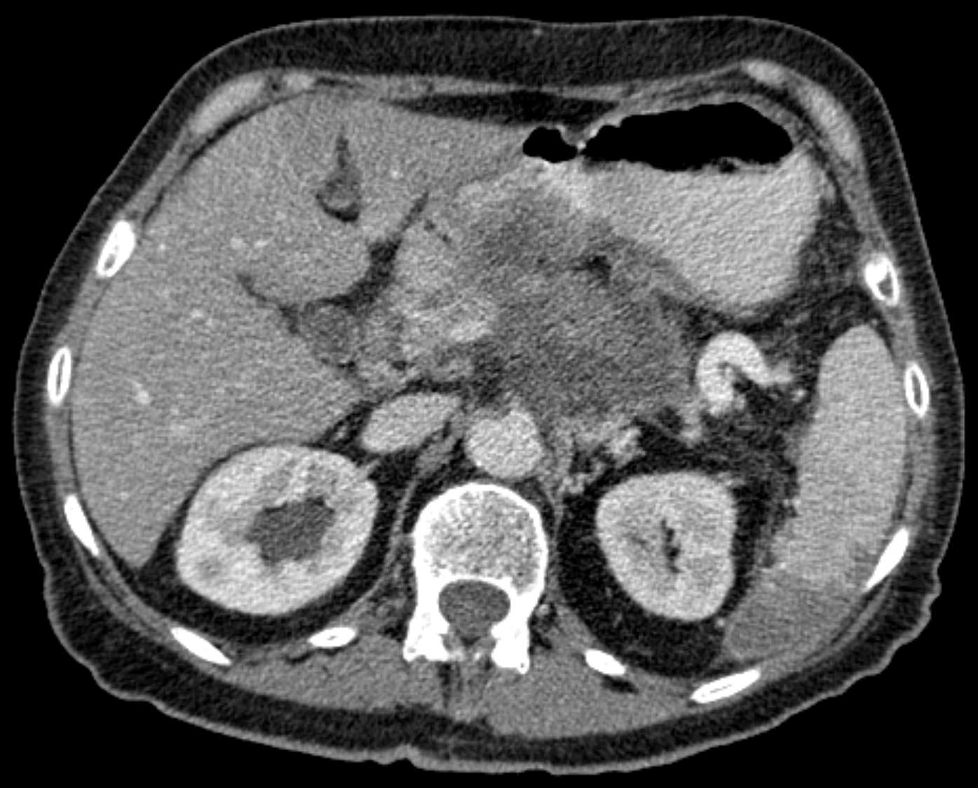 КТ‑скан с атрофией и кальцификацией поджелудочной железы (radiology+pancreas+CT) — источник: Wikimedia Commons, CC BY-SA 3.0