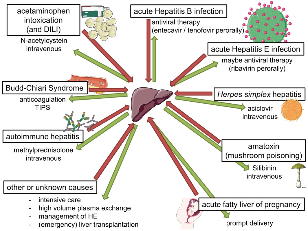 Etiologies and specific treatments for acute liver failure
