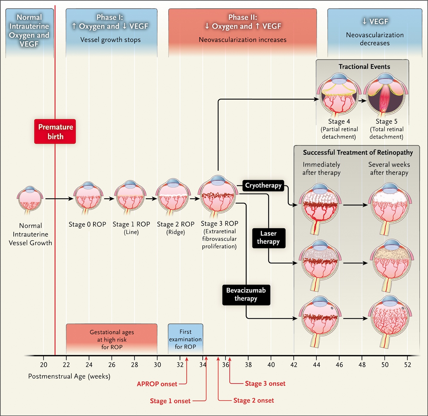Pathogenesis and Therapy of Retinopathy of Prematurity