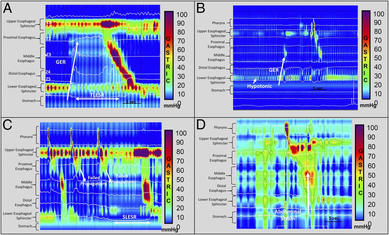 High-resolution impedance manometry images representing the main mechanisms of gastroesophageal reflux (GER) in infants