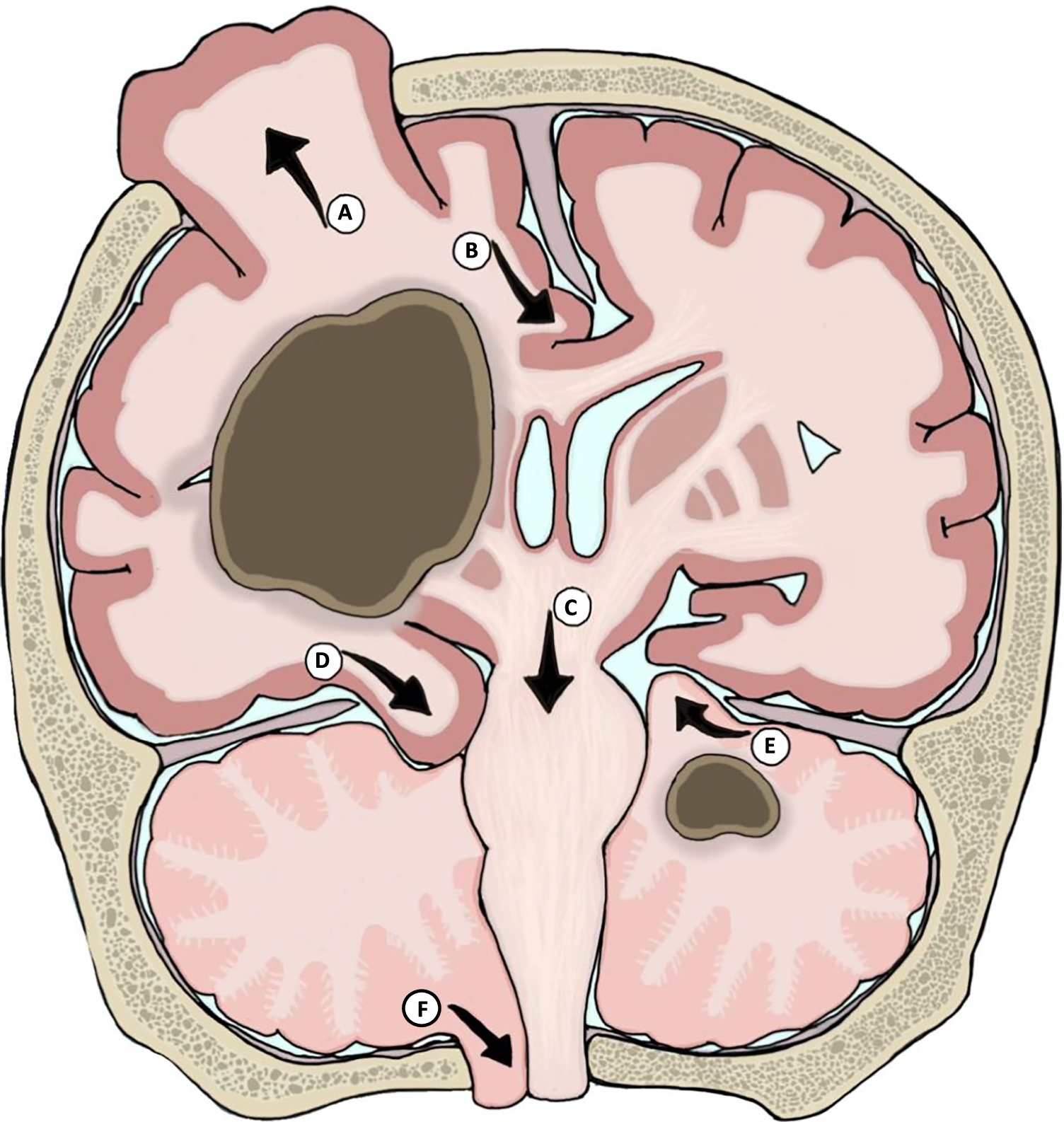 Herniation syndromes