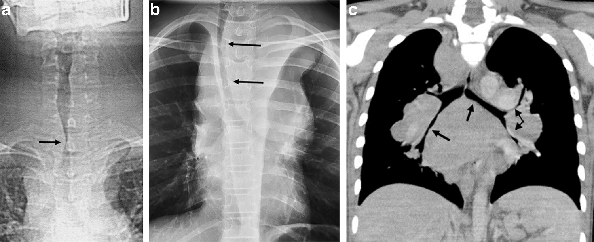 Airway compression at multiple levels in Hodgkin lymphoma