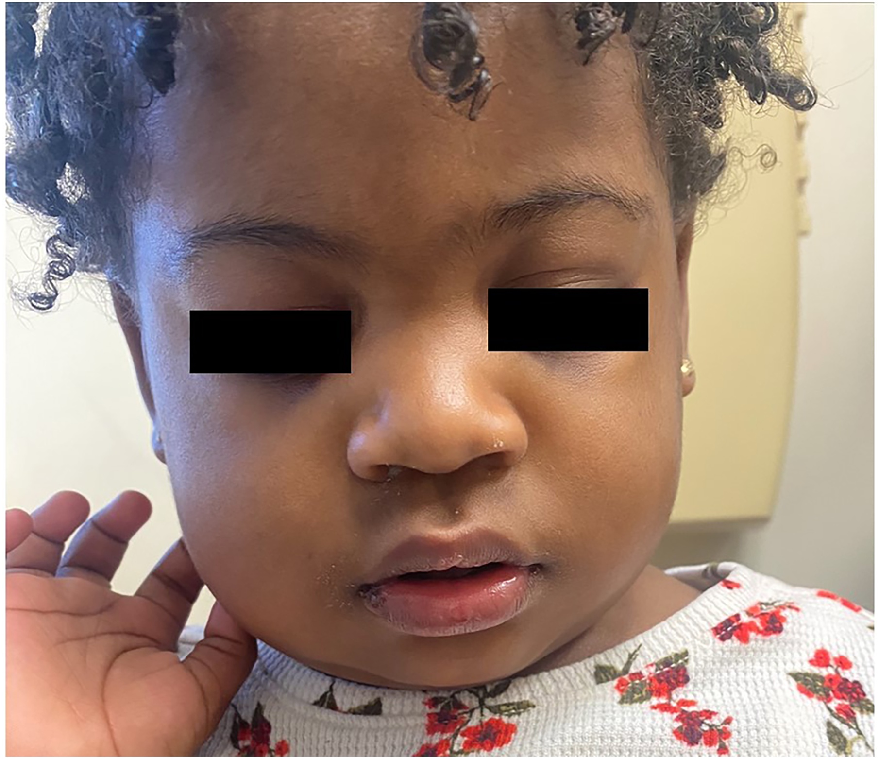 A 14-month-old with bilateral mumps parotitis who did not receive her first MMR vaccine