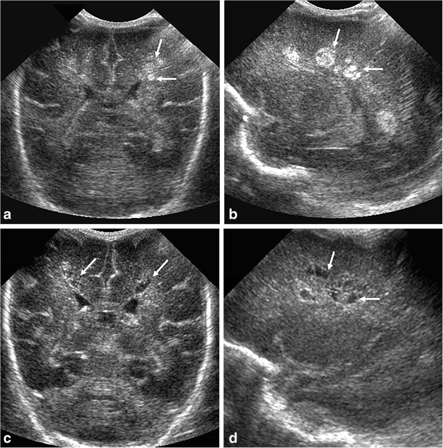 Periventricular leukomalacia (PVL) in a 21-day-old preterm boy (28 weeks' gestation) on brain ultrasound