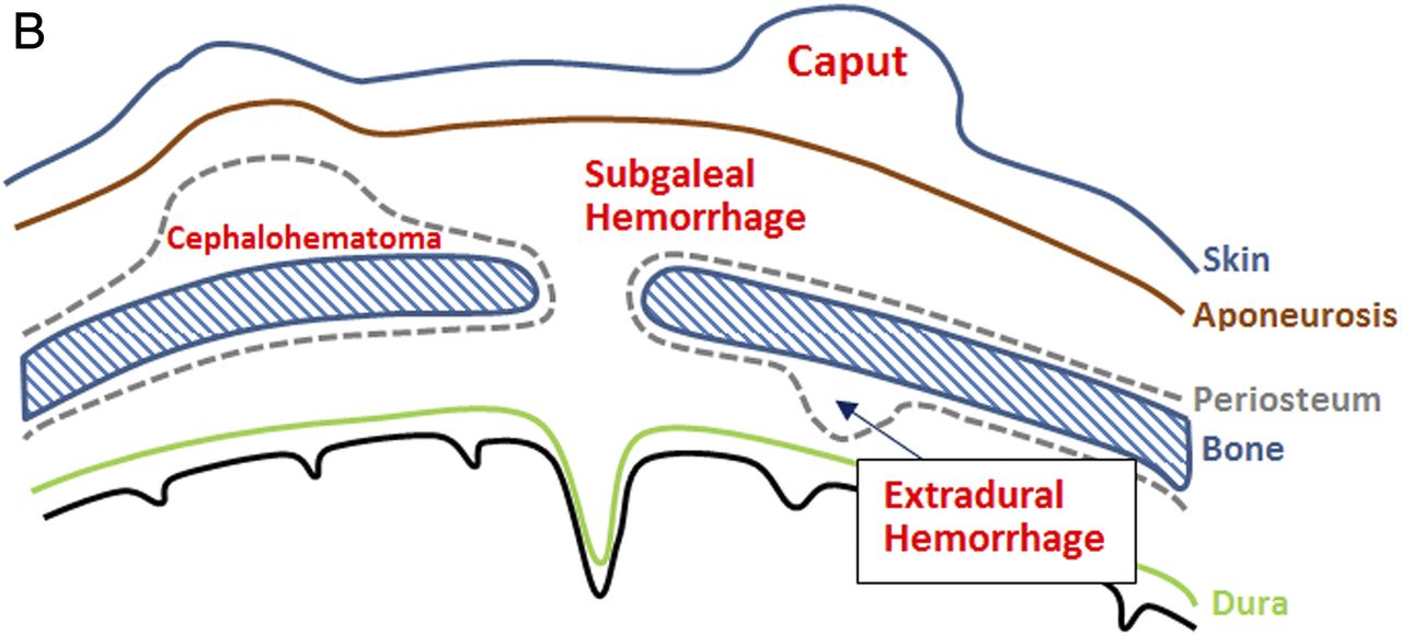 Locations of caput, cephalohematoma, subgaleal hemorrhage, and extradural hemorrhage