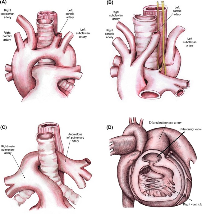 Vascular ring anatomy