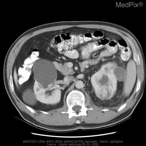 КТ с контрастированием при почечно-клеточном раке — источник: NLM MedPix (NLM MedPix, public domain (US Gov / NLM MedPix))