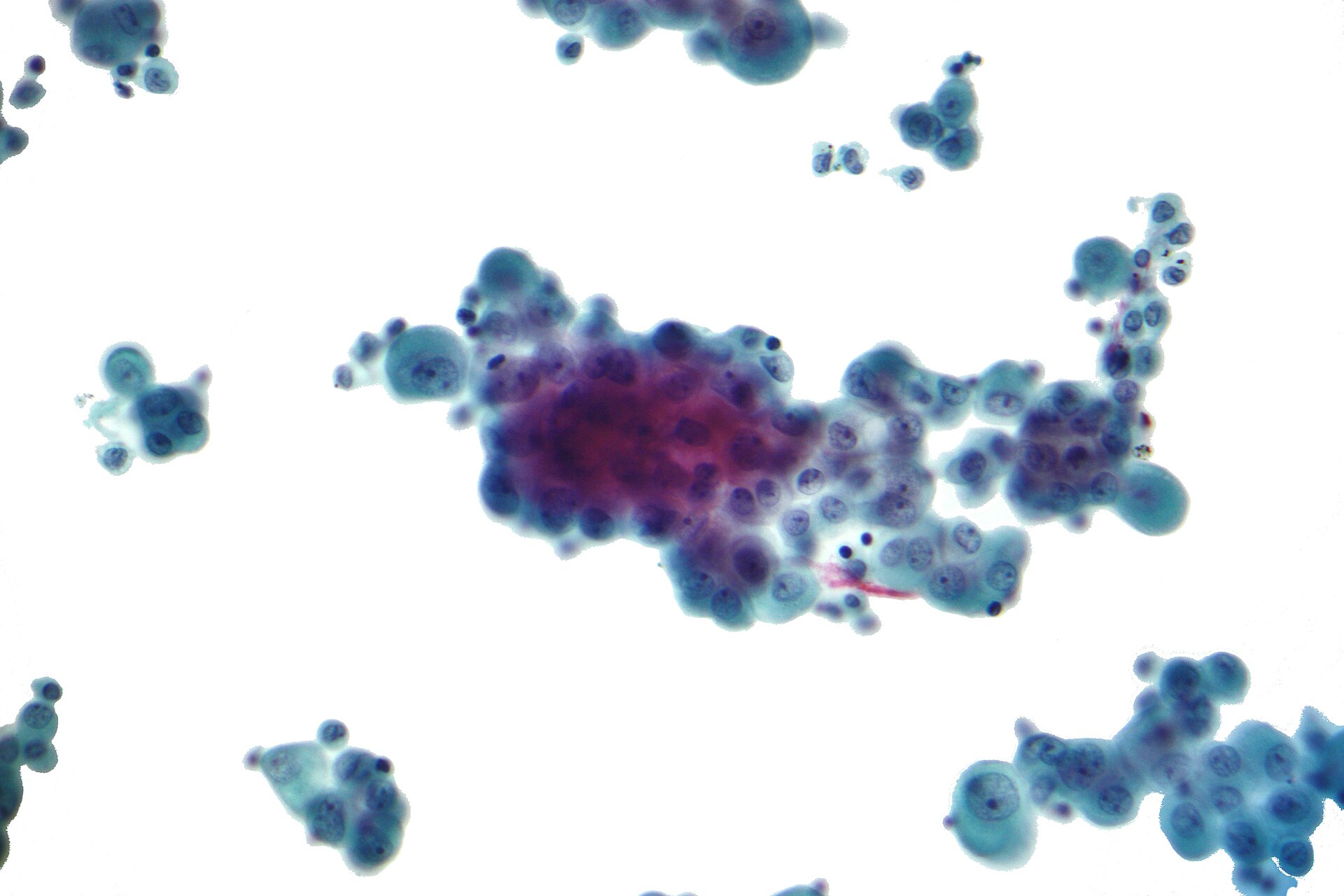 Гистологическая картина: Mesothelioma — источник: Wikimedia Commons (Nephron, CC BY-SA 3.0)