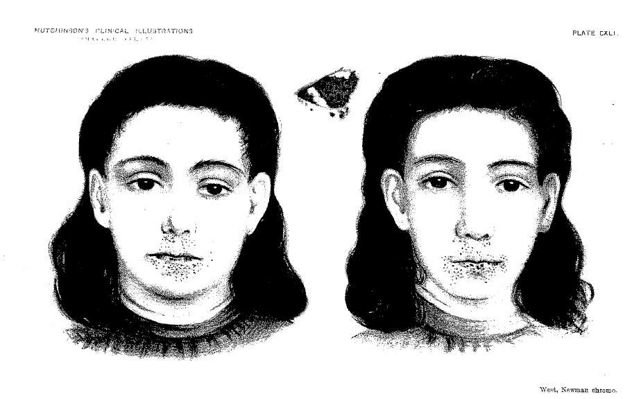 Историческая иллюстрация (Hutchinson's Clinical Illustrations): характерная периоральная пигментация — тёмные пятна вокруг рта при синдроме Пейтца-Егерса — источник: Wikimedia Commons, Public domain