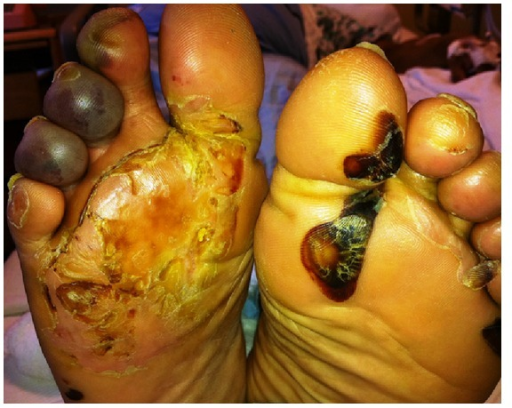 Клиническая картина: Erythropoietic Porphyria — источник: NLM Open-i (Case reports in hematology, open access (NLM Open-i))